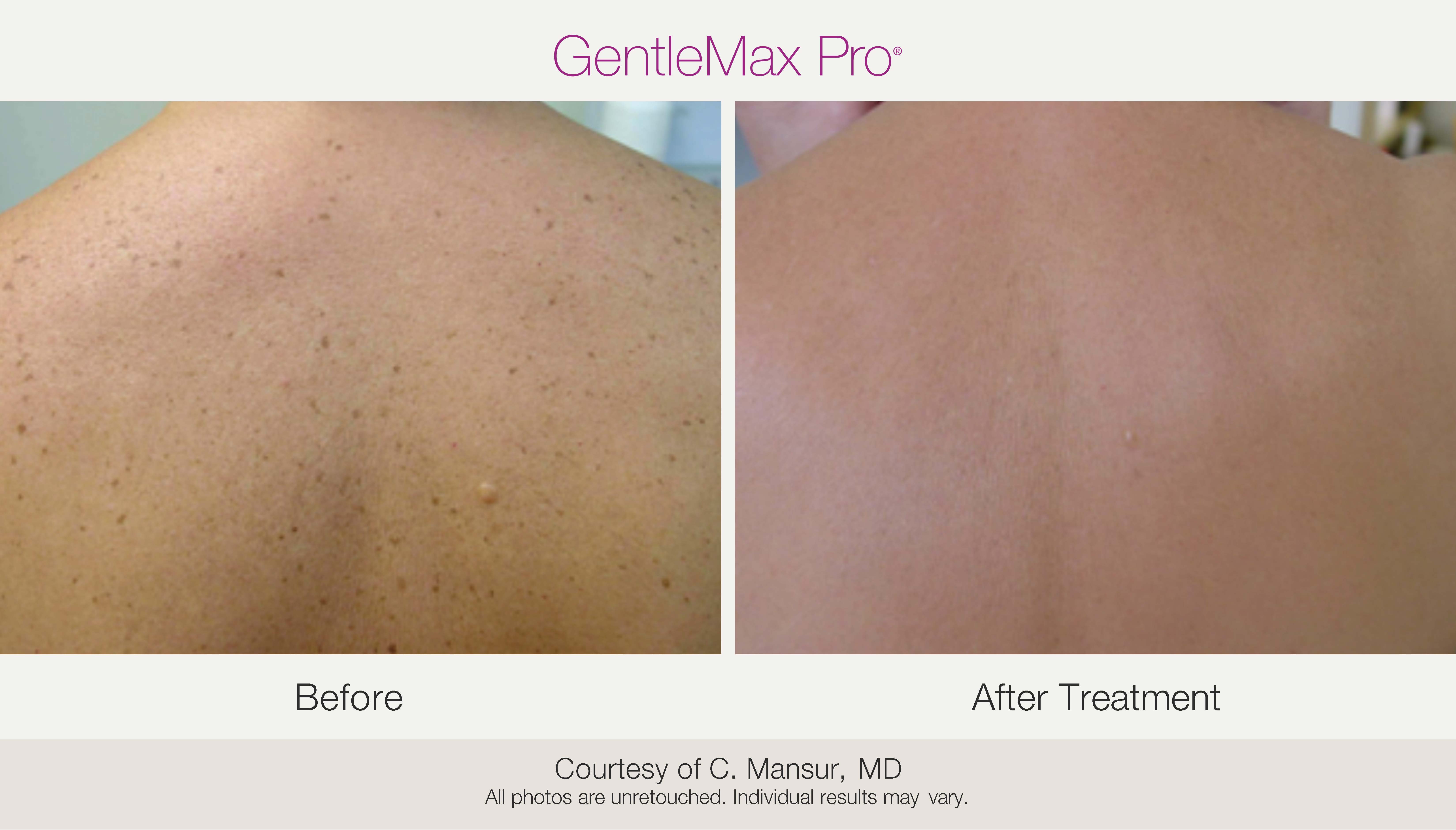 Résultat avant et après le traitement des taches pigmentaires au laser, révélant un teint plus uniforme.