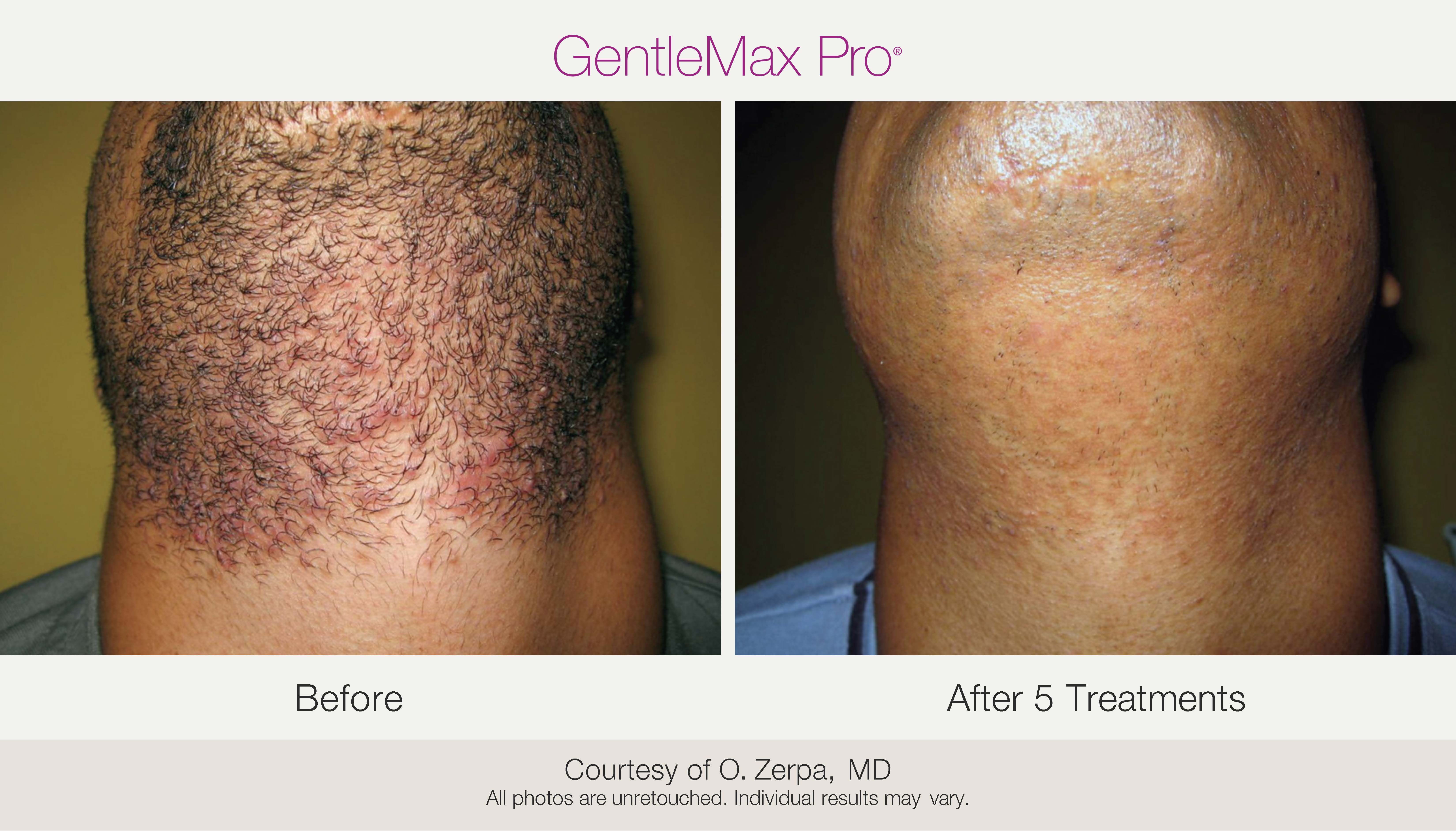 Transformation avant et après un traitement d'épilation laser, illustrant une peau lisse et sans irritation.